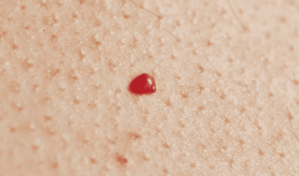 Красные пятна на коже: причины и лечение