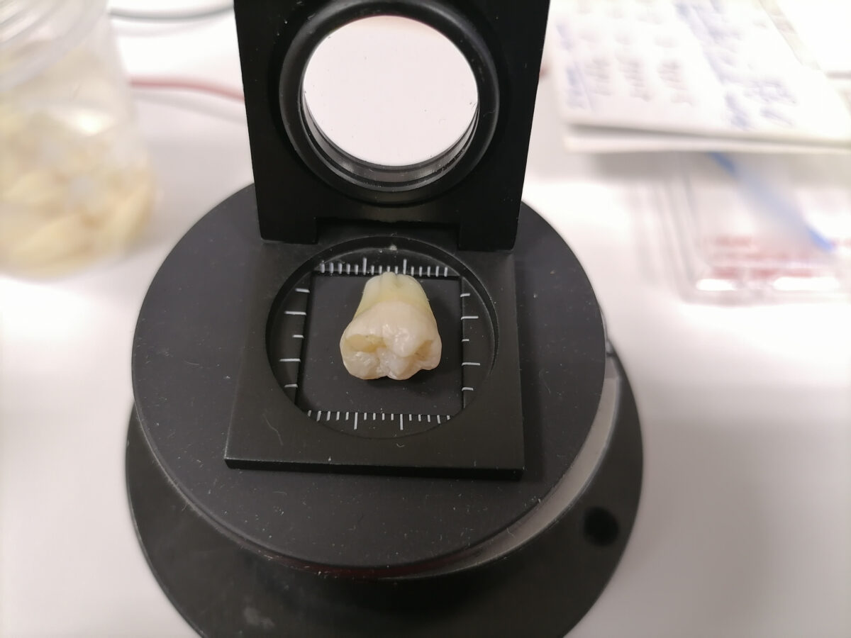 Для восстановления эмали. Российские ученые разработали зубное покрытие, подавляющее бактерии