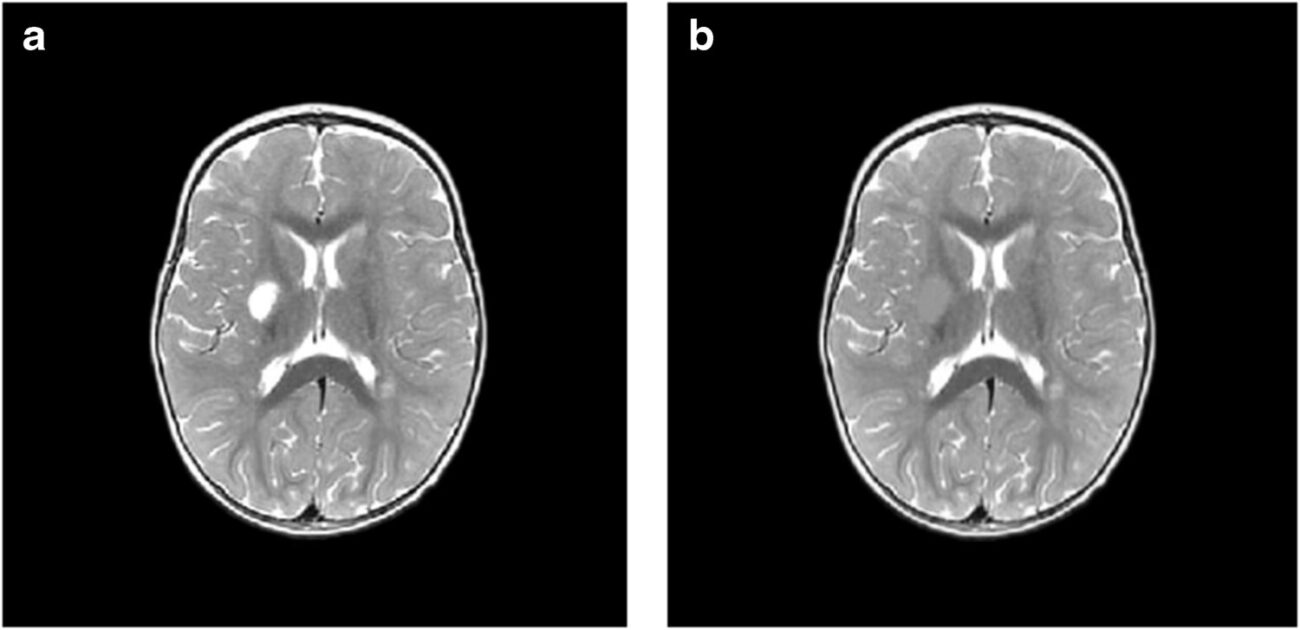 Зона поражения. Изучены различия в объеме повреждений мозга после инсульта у детей разного возраста