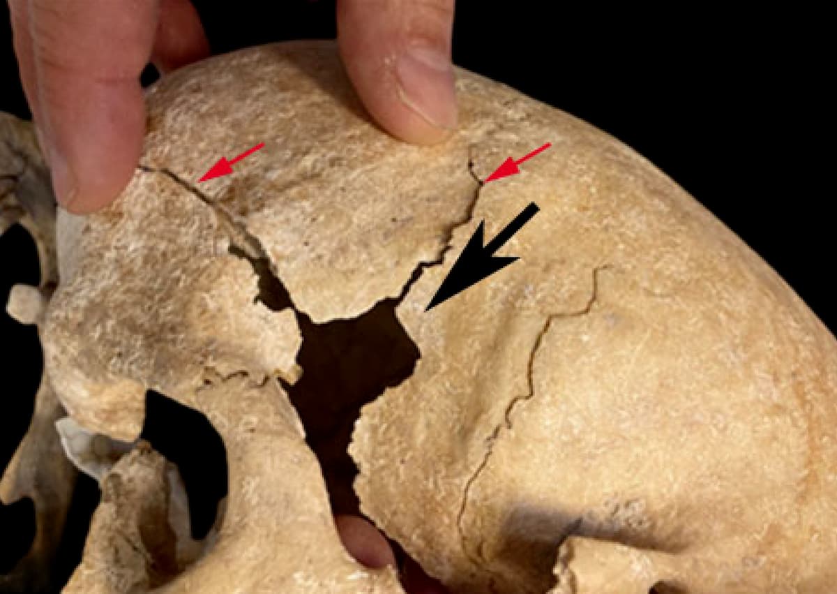 Невероятный случай: элитный воин, живший между XII-XV веками, страдал редким заболеванием, но дожил до 50 лет