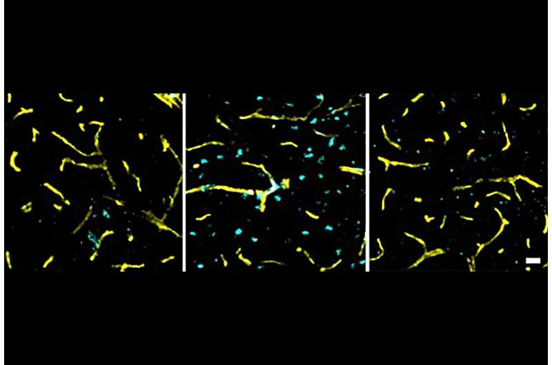 Новое исследование: гипертония начинает влиять на мозг гораздо раньше, чем думали ученые