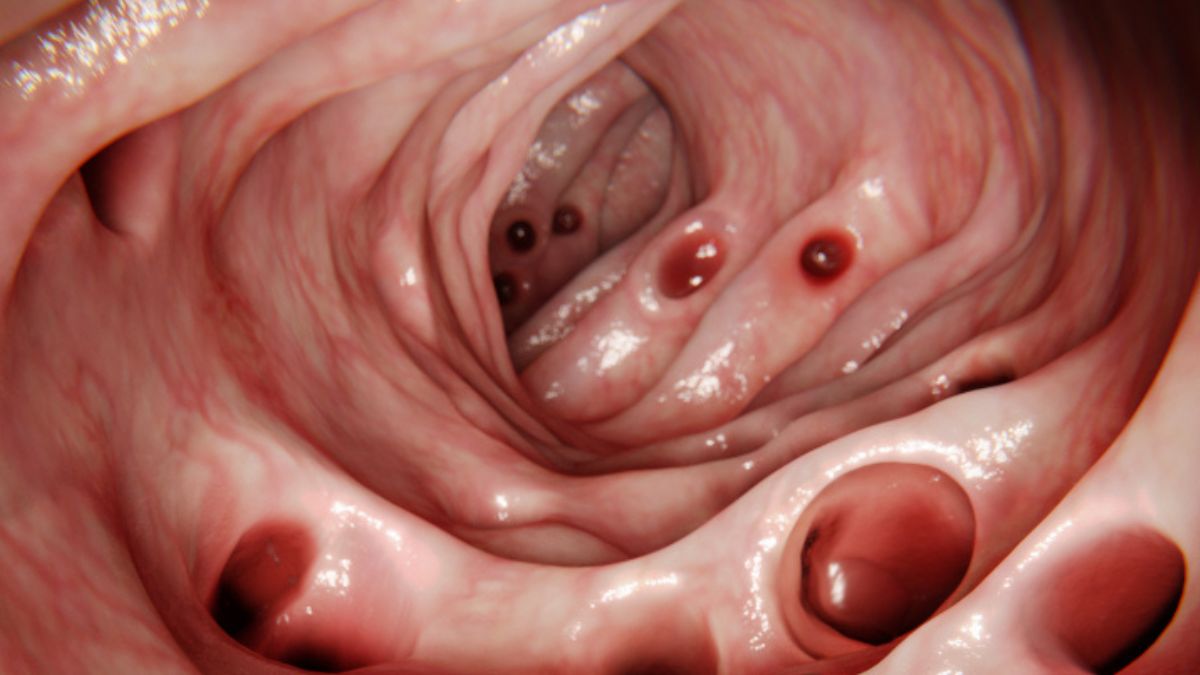 К 80 годам это находят у большинства: что такое дивертикулёз и почему не надо паниковать