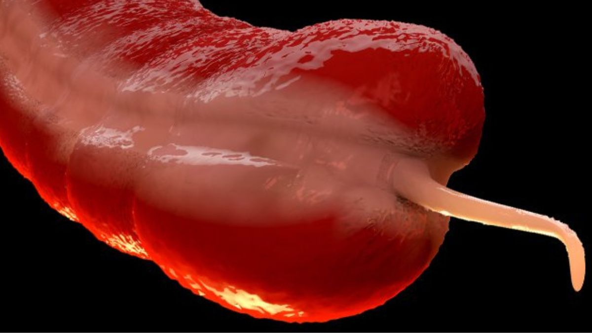 У миллениалов риск выше в разы: что происходит с раком аппендикса в США