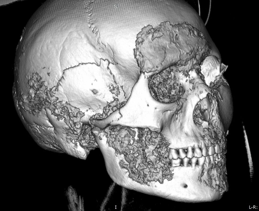 При компьютерной томографии черепа женщины V века до н.э. выявлены свидетельства хирургической операции