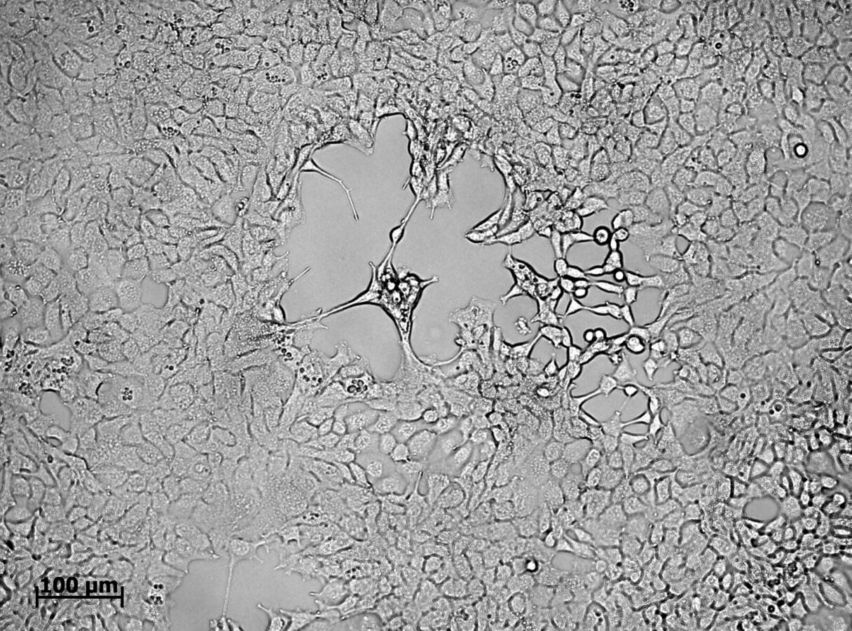 Создан вирус, который выборочно уничтожает раковые клетки, не трогая здоровые ткани организма